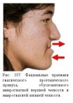 Fatsialnyie-priznaki-gnaticheskogo-progenicheskogo-prikusa.jpg